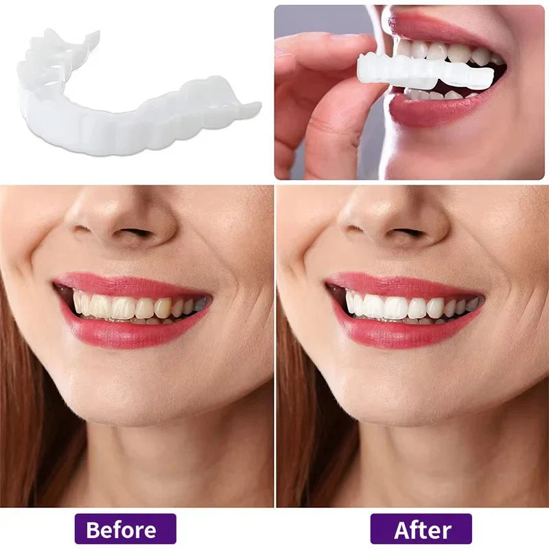 Snap on Smile Teeth Whitening veneers (Perfect Smile)